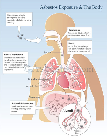 Asbestos Exposure Signs, Symptoms & Risks