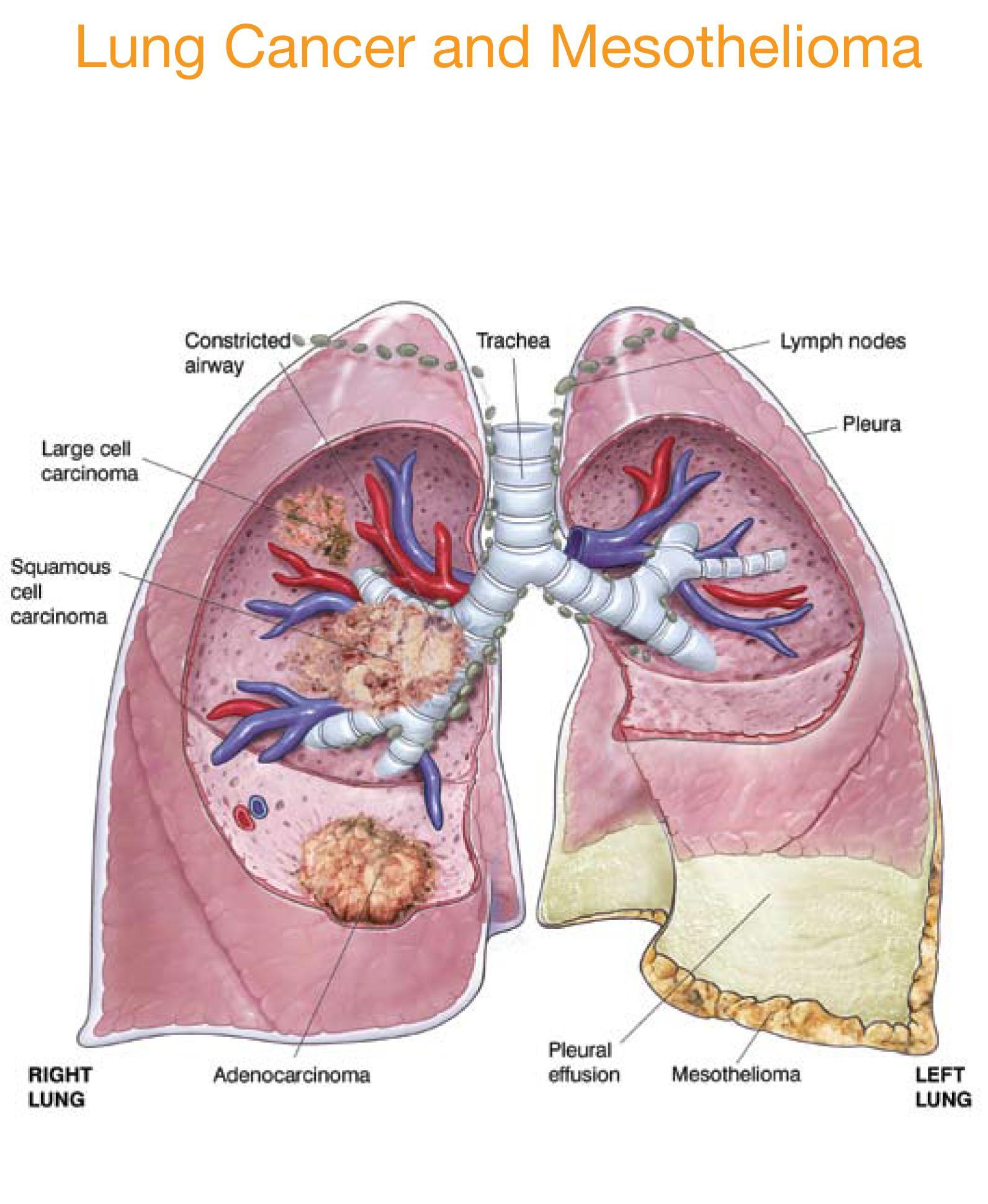 Lung Cancer