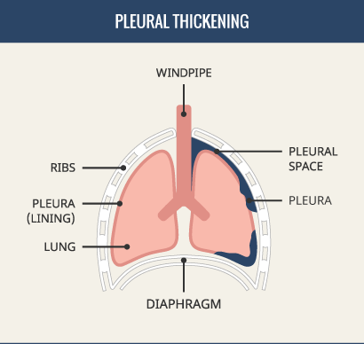 mesothelioma uk compensation