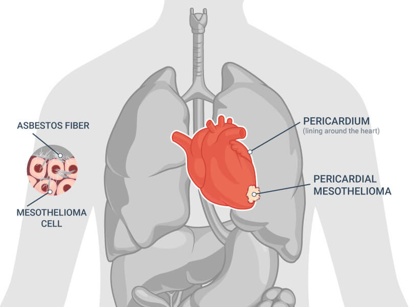 what is the life expectancy of someone with mesothelioma